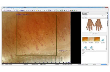 Optilia Digital Capillaroscopy System, Extensive kit